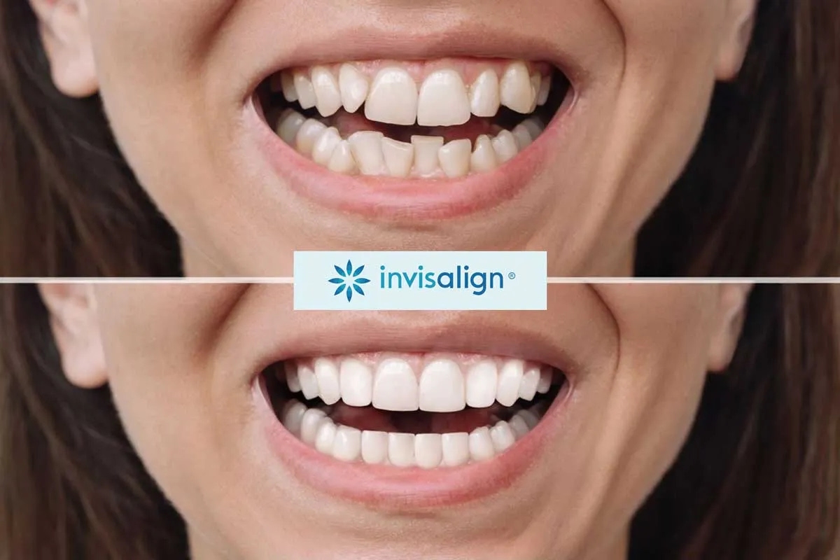 Kes Invisalign 3